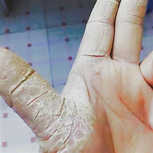 脱固鹅掌风痒角质化手癣手掌裂口顽皮发硬干裂手】掉皮疼真菌感染