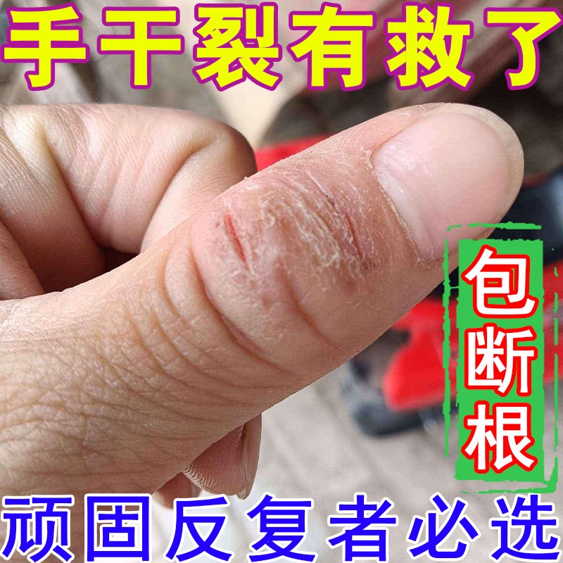 速发手干裂脱皮真菌感染手指开裂痒治成人儿童手足脚干裂去死皮修