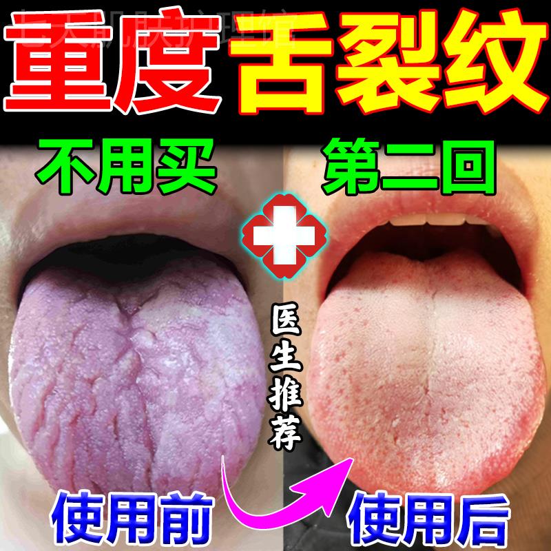 舌头中间有裂纹齿痕地图舌调理舌头发白发厚湿气舌头疼麻舌焱喷剂