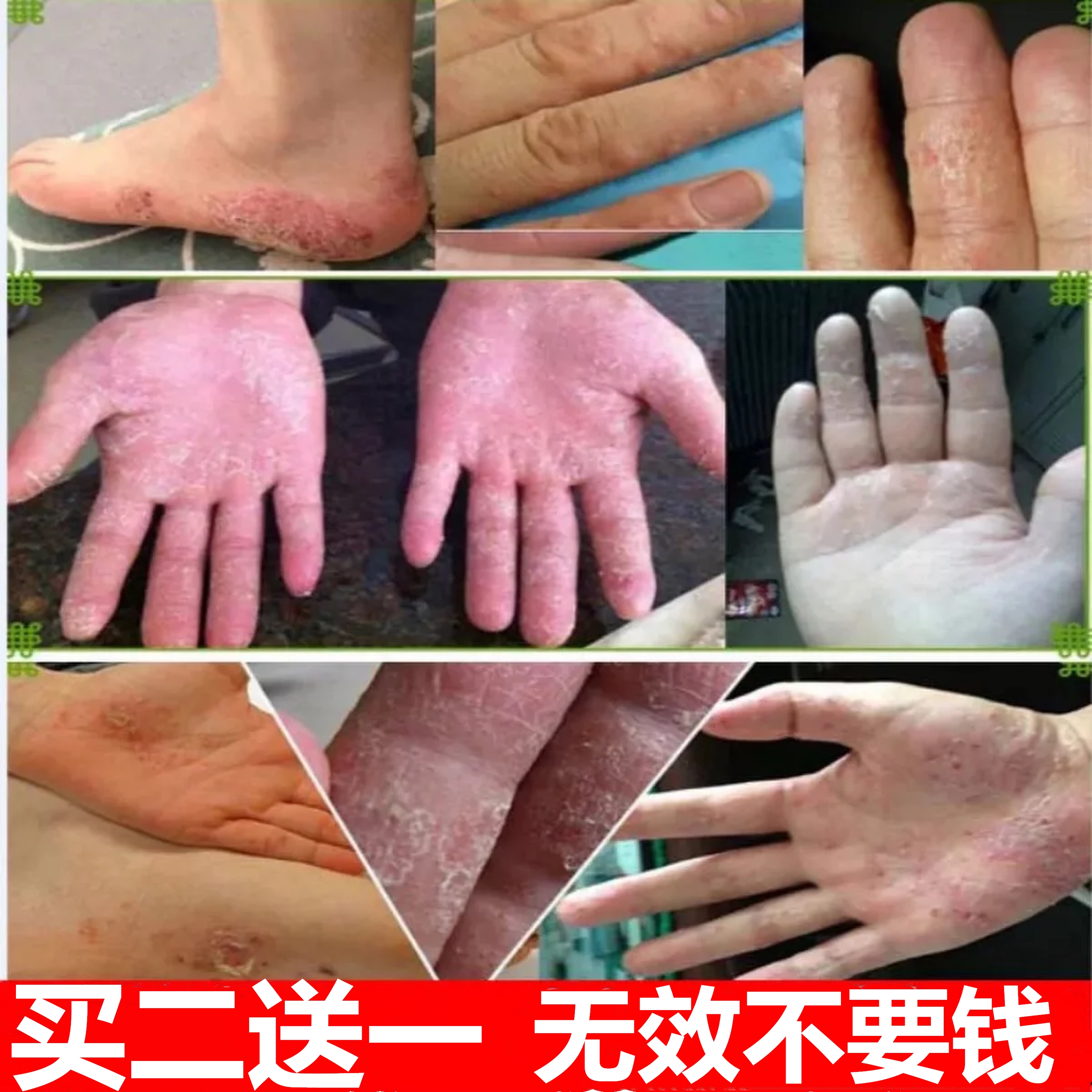 鹅掌风真菌感染手癣膏脱皮干裂抑菌汗疱疹手部脚癣手足藓专用药膏