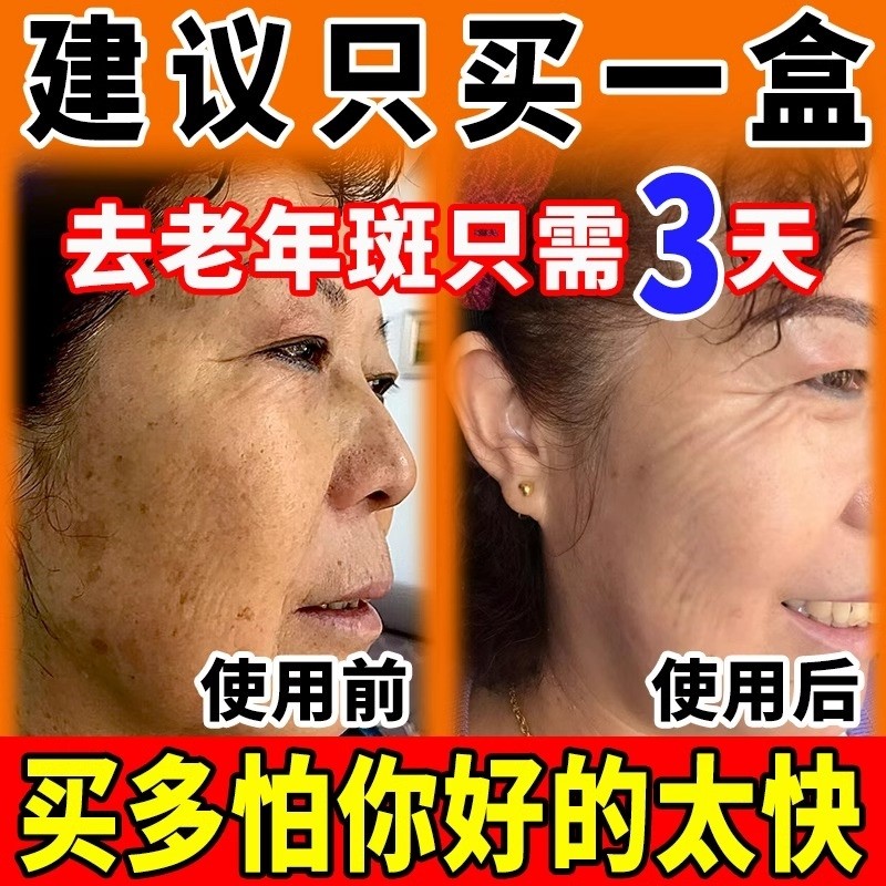 老年斑强力去除手部脸部专用老人祛霜斑祛黄褐斑雀斑官方正品斑去