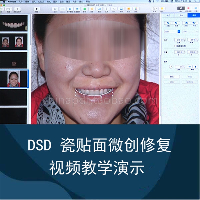 DSD 全瓷贴面微创修复技术 真人操作教学高清视频 瓷贴面课程 c1